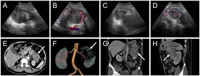 Primary renal myxoid liposarcoma with pancreatic invasion on 18F-FDG PET/CT: first case report and literature review